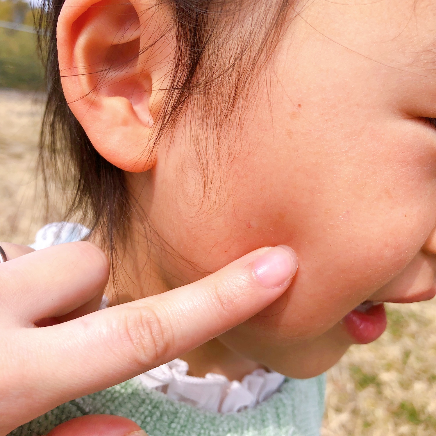 子どものほっぺたにプロペトを塗る。